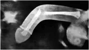 penis-fracture.webp