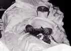 27 year-old surgeon Leonid Rogozov performs his own appendectomy.webp