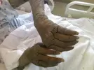 Norwegian_Scabies_in_Homeless_AIDS_Patient.webp